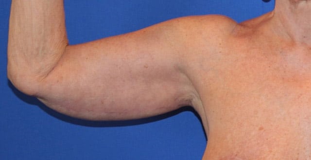 After Image: Patient Case #1107 - front