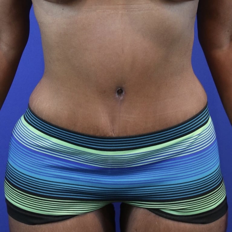 After Image: Patient Case #3119 - front