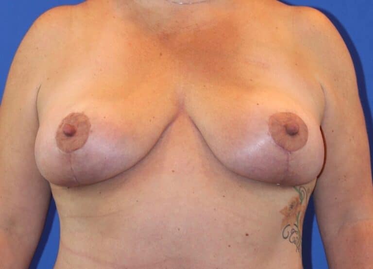 After Image: Patient Case #3868 - front