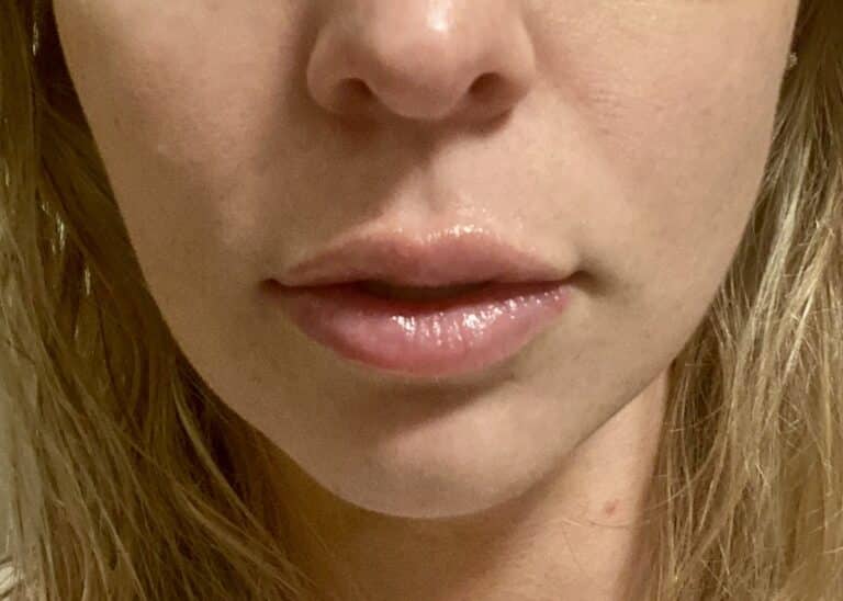 After Image: Patient Case #1010 - front
