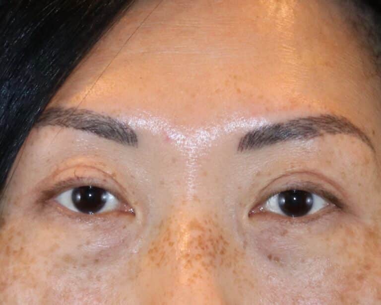 After Image: Patient Case #3332 - front