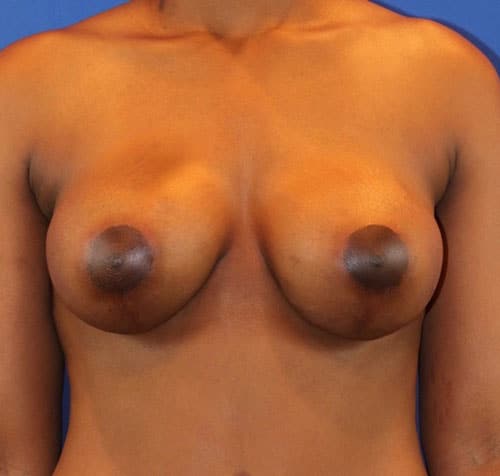After Image: Patient Case #3017 - front