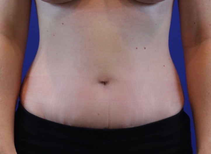 After Image: Patient Case #3988 - front