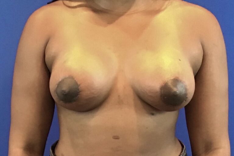 After Image: Patient Case #3423 - front