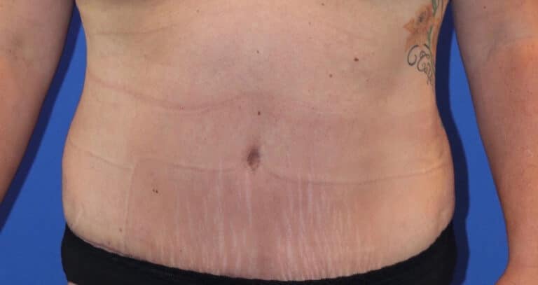 After Image: Patient Case #3869 - front