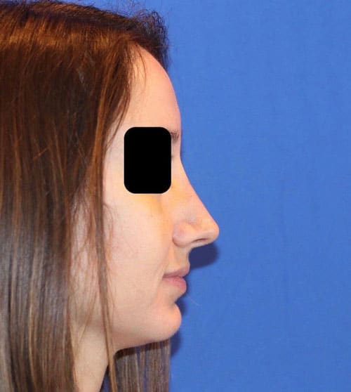 After Image: Case Patient 2 - right-side