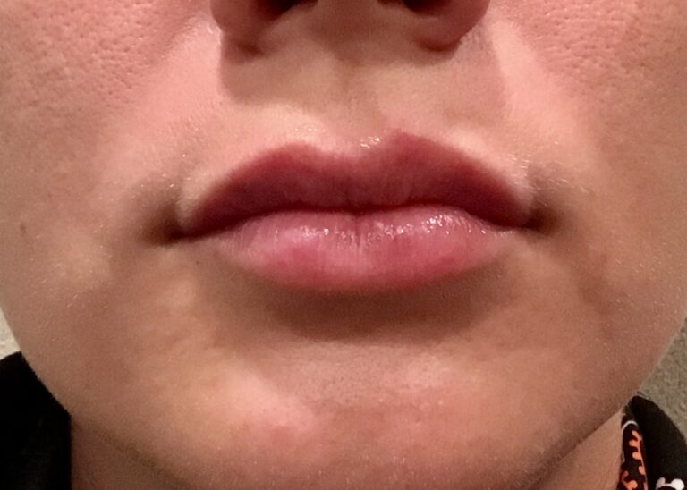 After Image: Patient Case #1006 - front