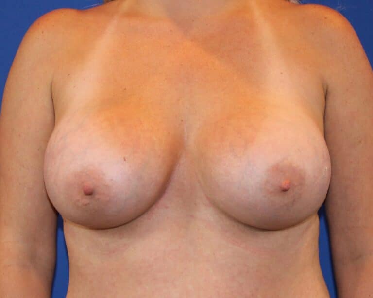 After Image: Patient Case #3331 - front