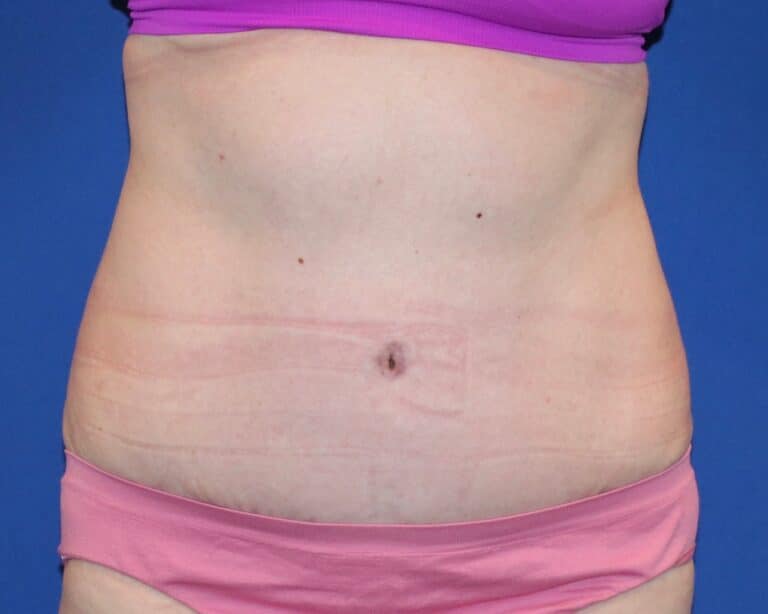 After Image: Patient Case #3882 - front