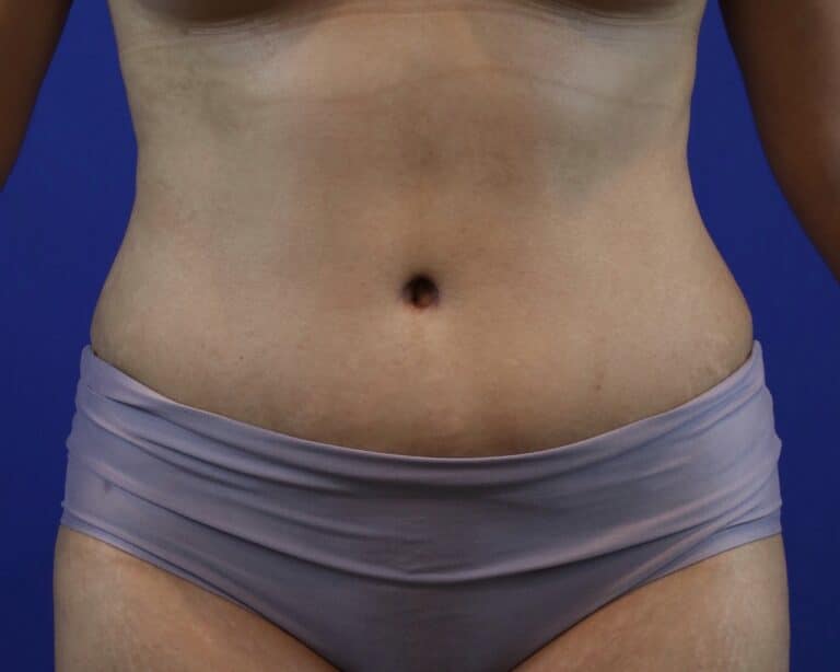 After Image: Patient Case #3109 - front