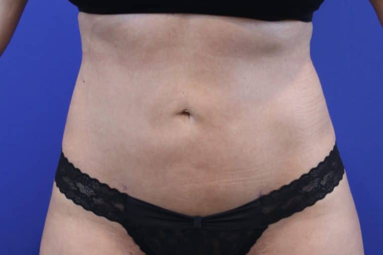 After Image: Patient Case #3215 - front