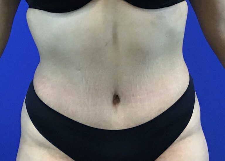 After Image: Patient Case #3883 - front