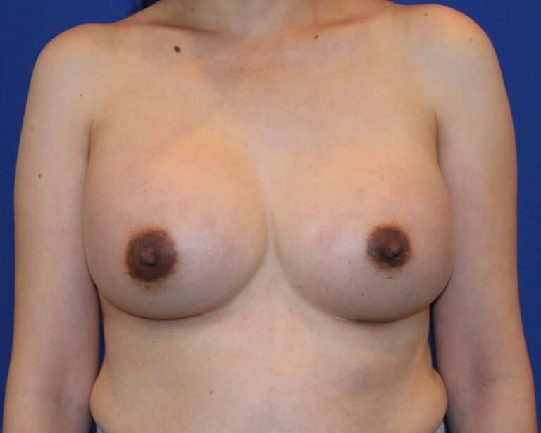 After Image: Patient Case #3425 - front