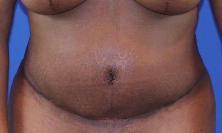 After Image: Patient Case #3118 - front