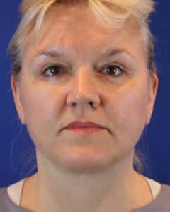 After Image: Patient Case #3614