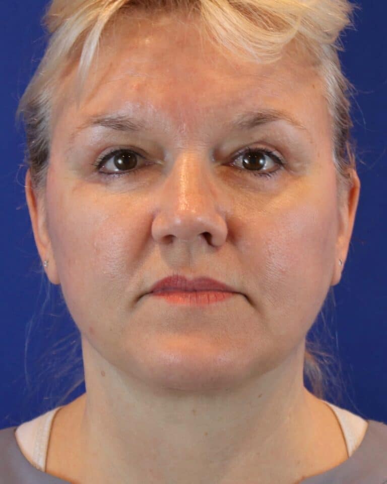 After Image: Patient Case #3614 - front