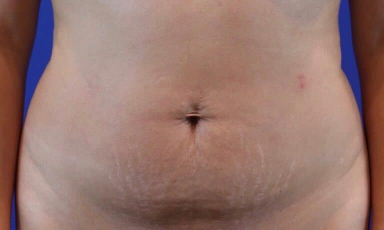 Before Image: Patient Case #3776 - front