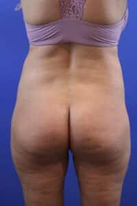 Before Image: Patient Case #4010