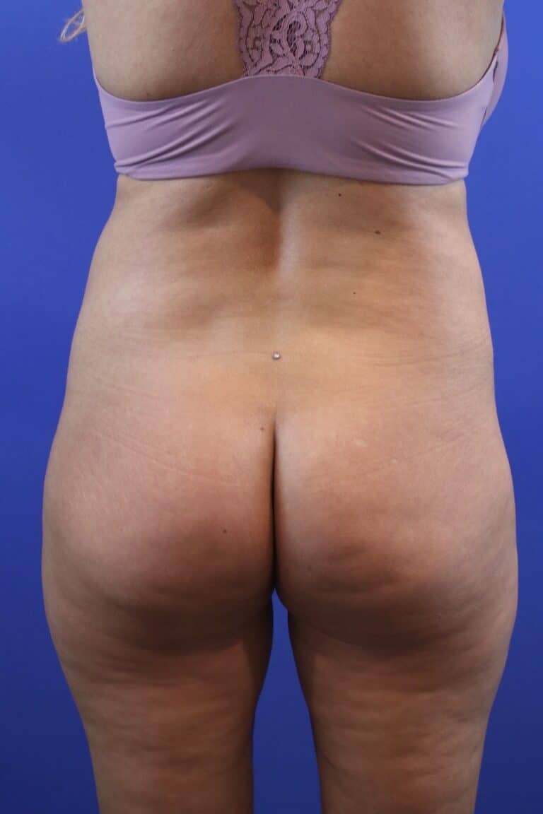 Before Image: Patient Case #4010 - front