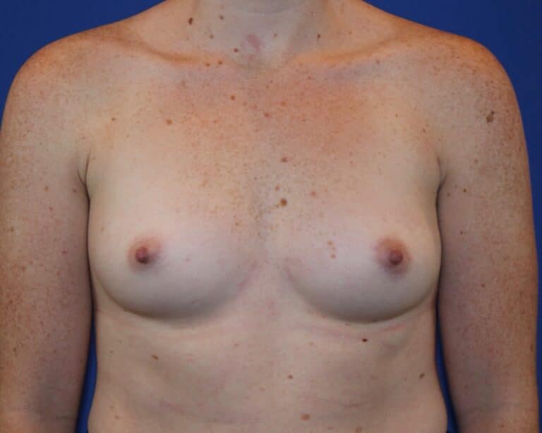 Before Image: Patient Case #2907 - front