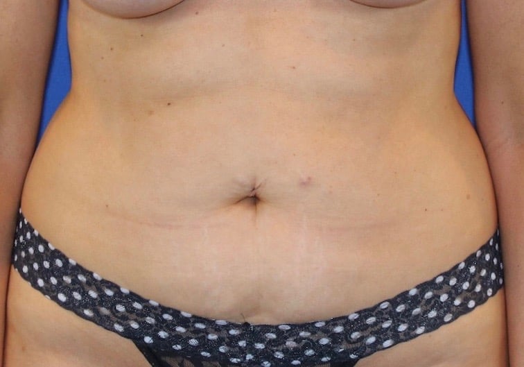 Before Image: Patient Case #3871 - front