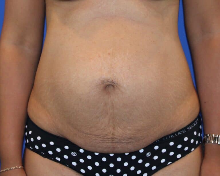 Before Image: Patient Case #3867 - front