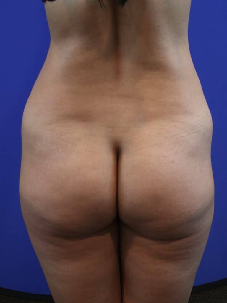 Before Image: Patient Case #4012 - front