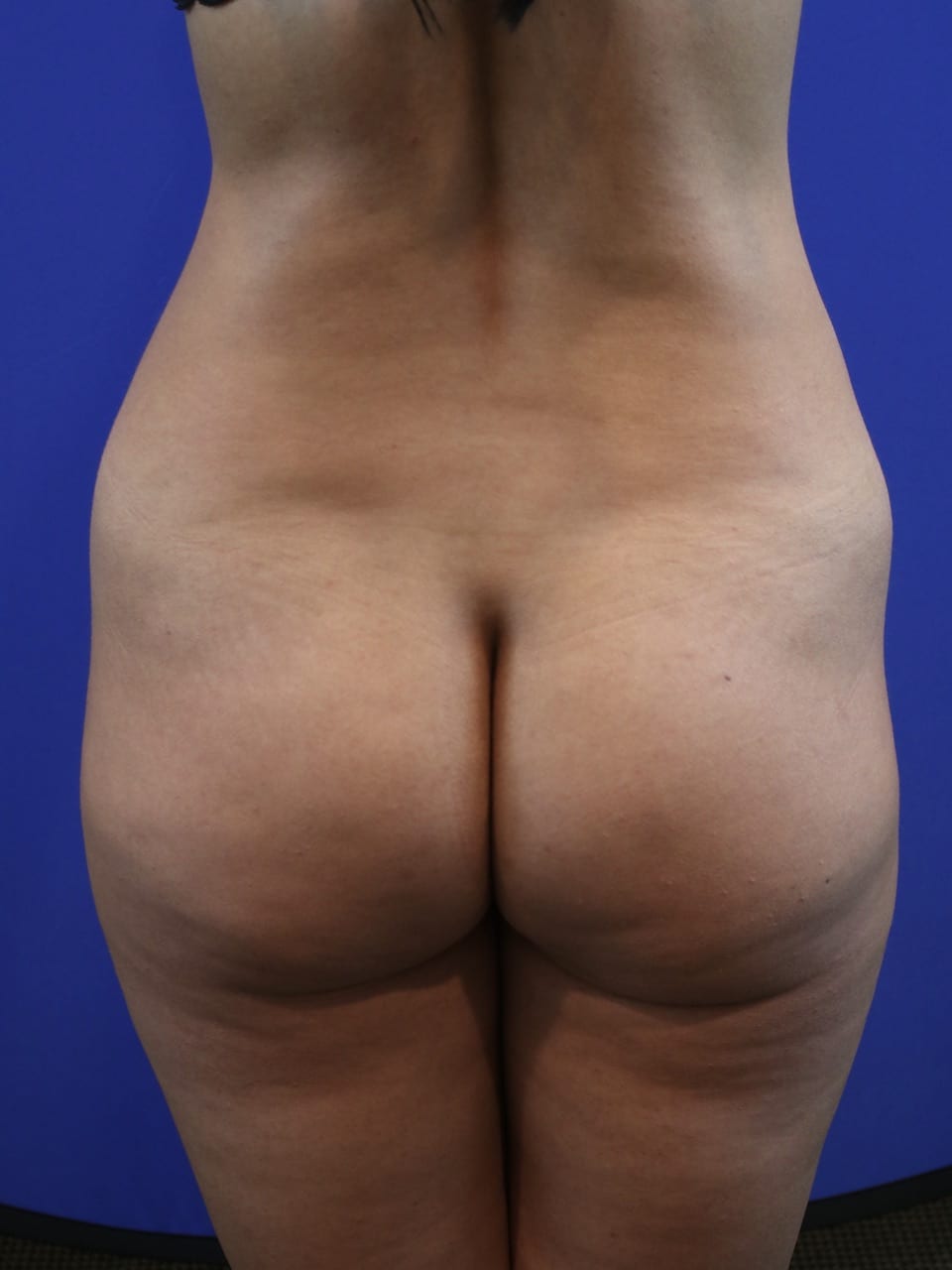 before BBL Surgery Dallas TX