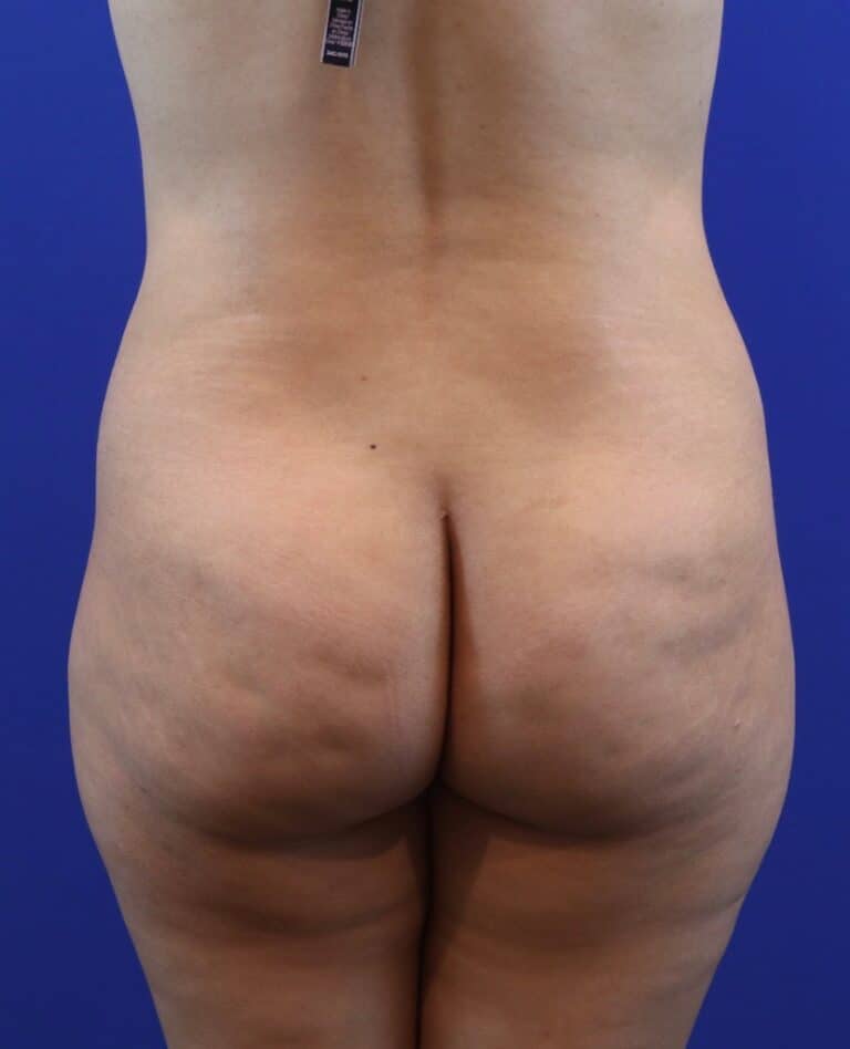 Before Image: Patient Case #4002 - back