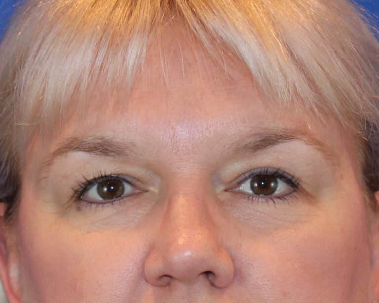 Before Image: Patient Case #3068 - front