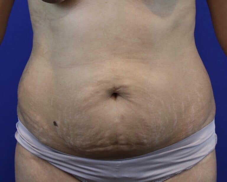 Before Image: Patient Case #3109 - front