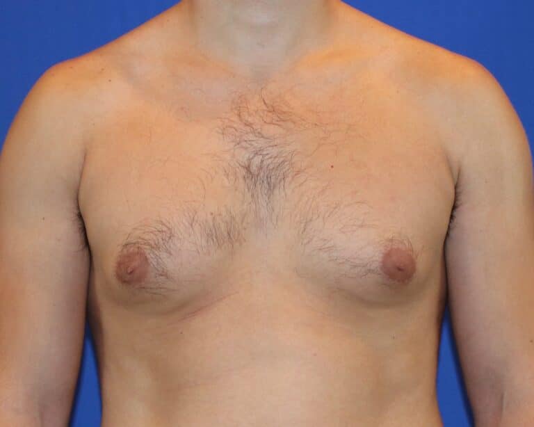 Before Image: Patient Case #1053 - front