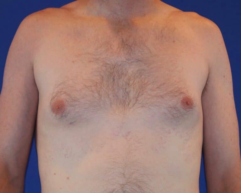 Before Image: Patient Case #1049 - front