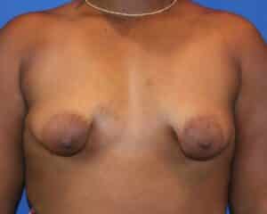 Before Image: Patient Case #3920