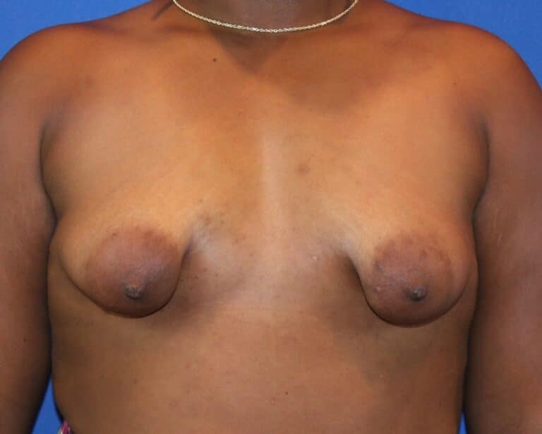 Before Image: Patient Case #3920 - front