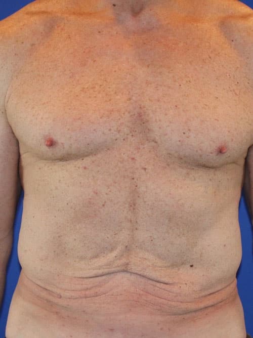 Before Image: Patient Case #3990 - front