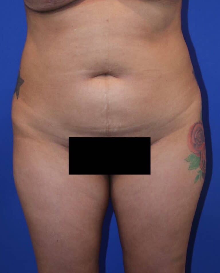 Before Image: Patient Case #3214 - front