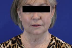 Before Image: Patient Case #3621
