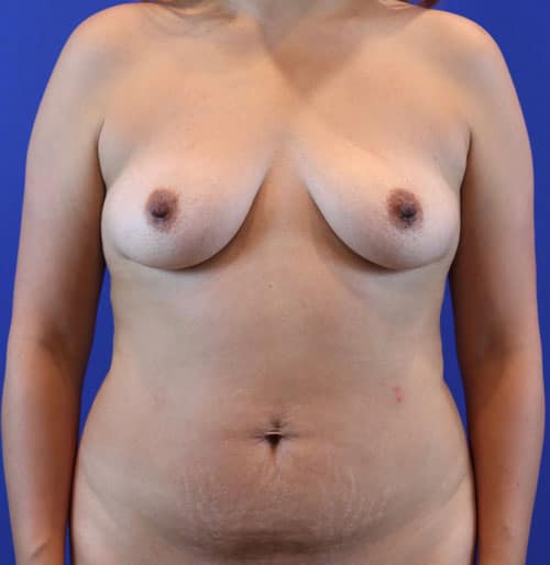 Before Image: Patient Case #3005 - front