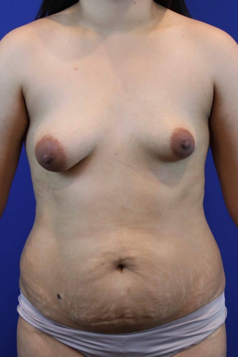 Before Image: Patient Case #3105 - front