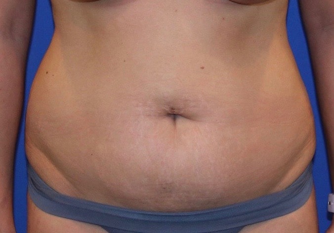 Before Image: Patient Case #3890 - front