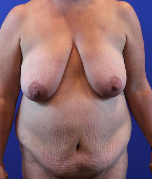 Before Image: Patient Case #3006 - front