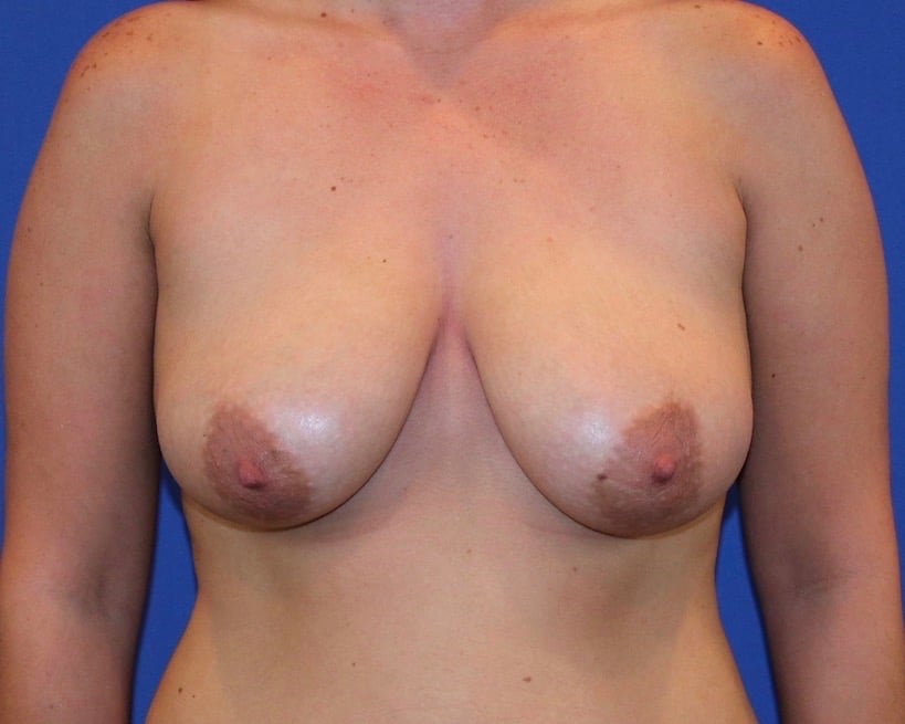 before Breast Lift Dallas TX