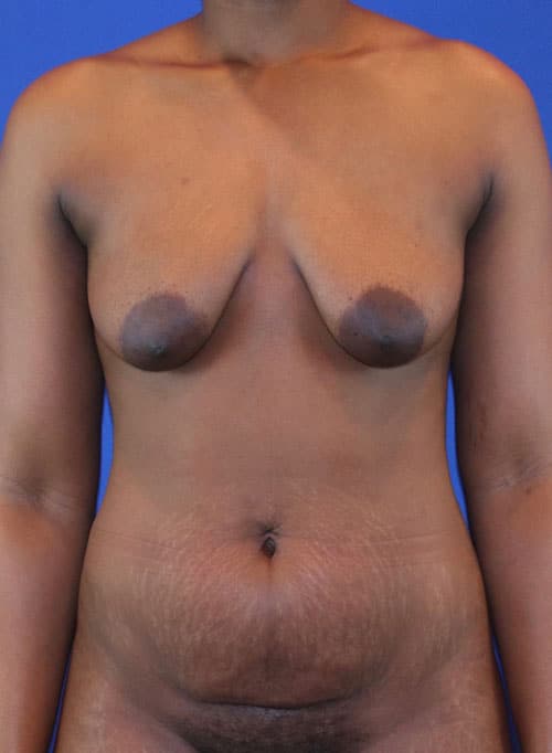 Before Image: Patient Case #3002 - front