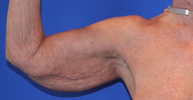 Before Image: Patient Case #1107 - front