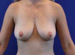 Before Image: Patient Case #3026