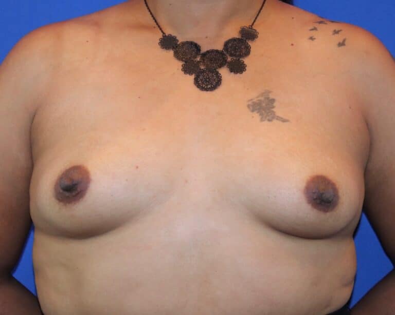 Before Image: Patient Case #5749 - front