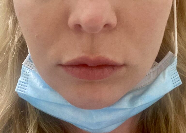 Before Image: Patient Case #1010 - front