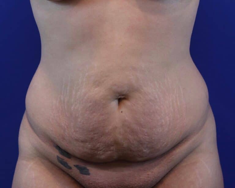 Before Image: Patient Case #3884 - front