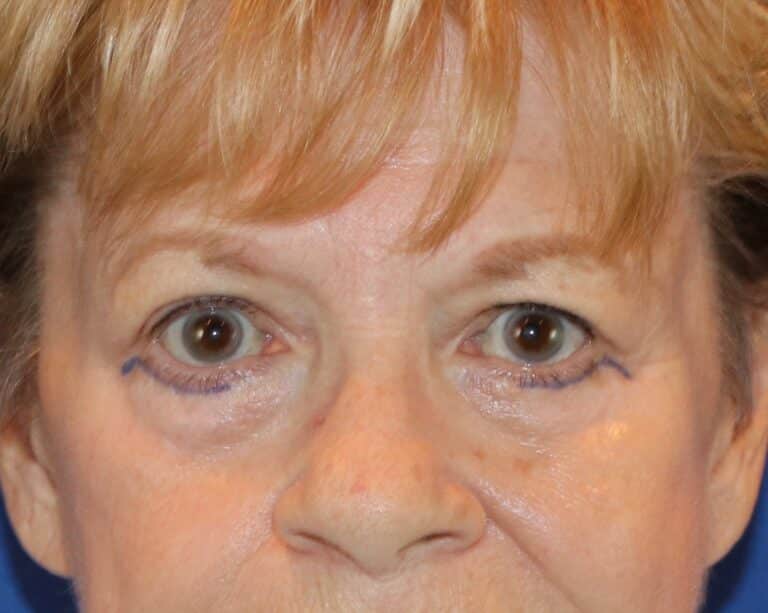 Before Image: Patient Case #3310 - front